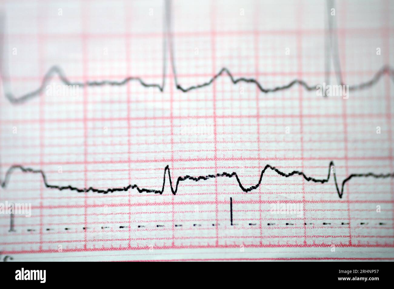 Ein EKG, ein Diagramm, das die Elektrizität des Herzens zieht und eine Vorstellung von der Herzerkrankung und dem Rhythmus gibt und alle ausschließt Stockfoto