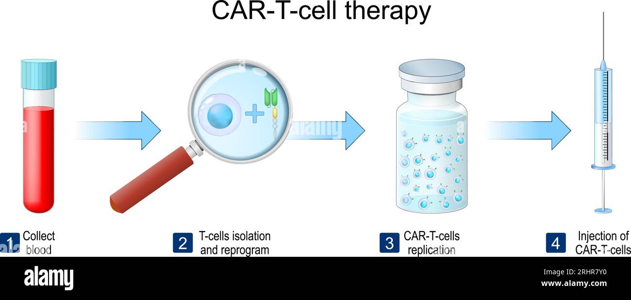 CAR-T-Zell-Therapie. Schritte des medizinischen Verfahrens zur Abtötung von Tumorzellen von der Blutgewinnung zur T-Zell-Isolierung, -Umprogrammierung und -Replikation. Genetica Stock Vektor