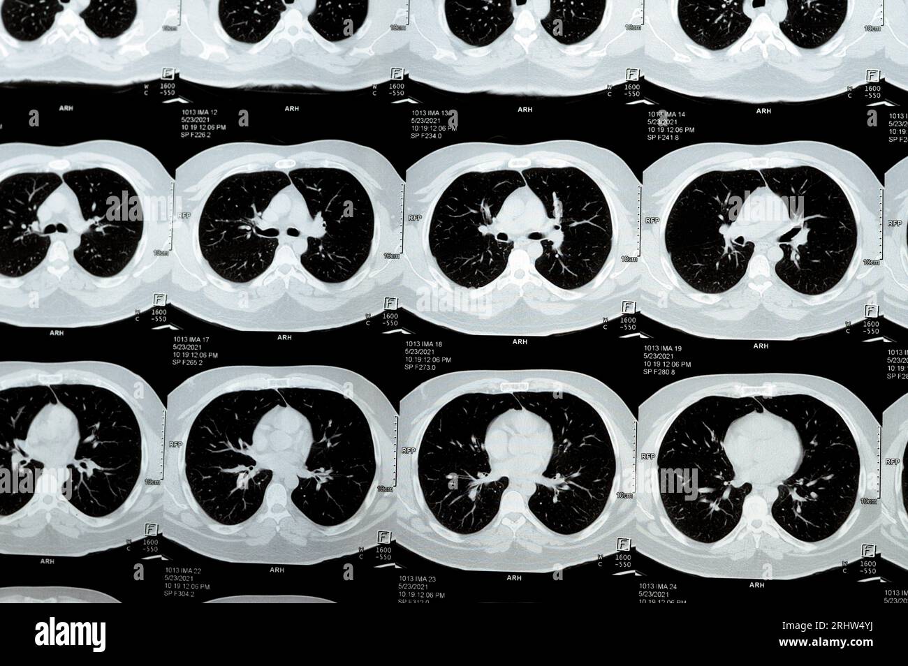 Mehrschicht-CT-Scan der Brust mit normaler Untersuchung, normalem Lungenbild, Parenchym, Lungengefäß, mediastinalen Strukturen, nein Stockfoto