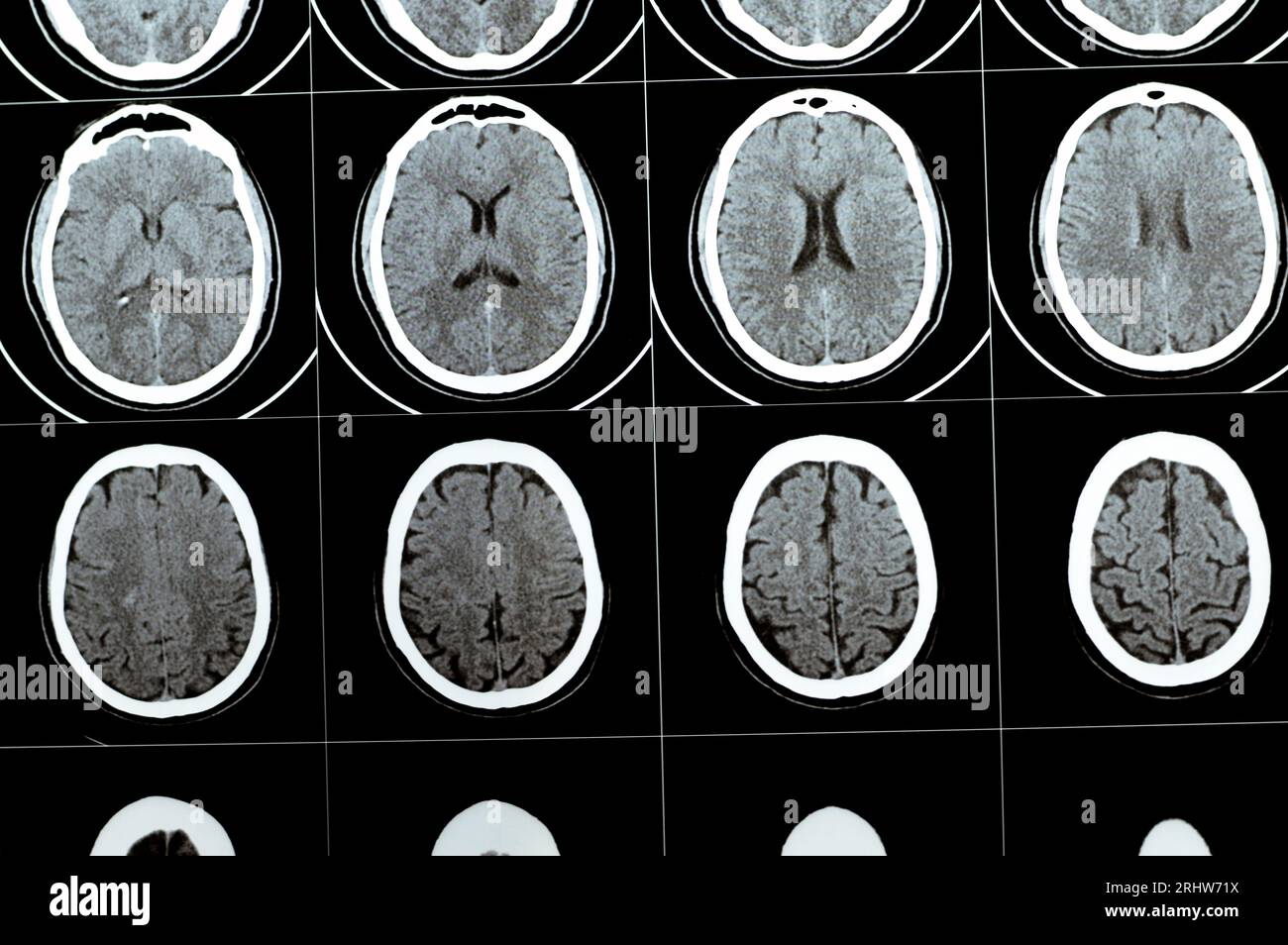 Mehrschicht-CT-Scan des Gehirns mit großem Hirnstamm und semiovalen Hämatom des rechten Zentrums, normalen hinteren Fossa-Strukturen, normaler Vent-Größe Stockfoto