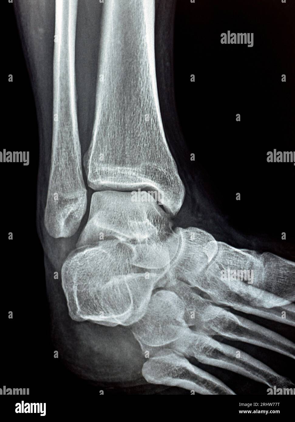 Einfache Röntgenaufnahme des rechten Sprunggelenks mit syndesmotischer Knöchelverstauchung, einer Verletzung eines oder mehrerer Bänder, die das distale Tibiofibulum umfassen Stockfoto