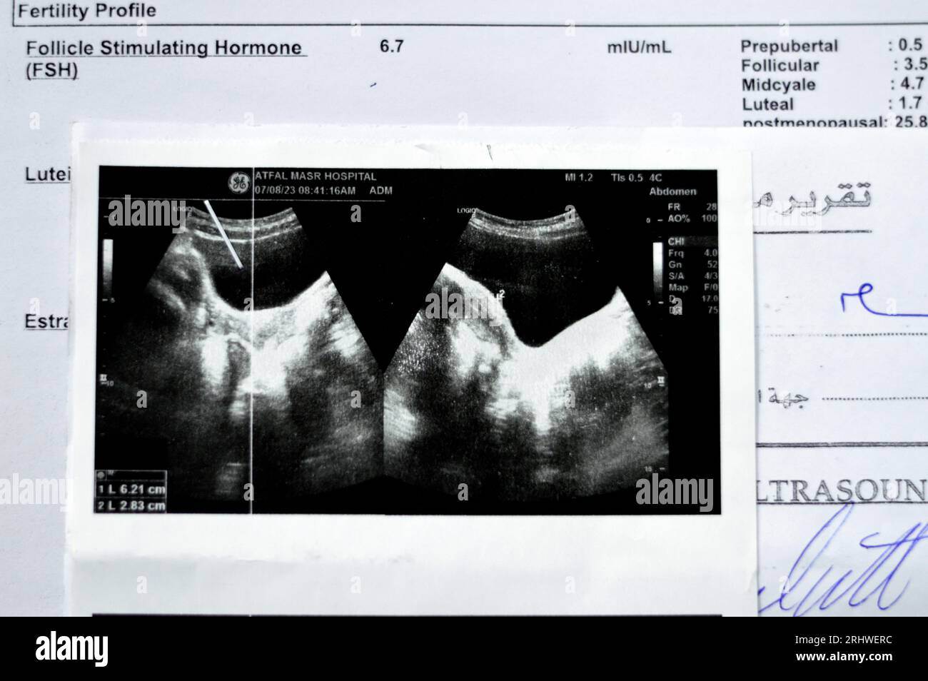 Kairo, Ägypten, 9. August 2023: Diagnostische pelviabdominelle Sonographie für ein junges Teenager-Mädchen mit normaler Nierenfunktion ohne ston Stockfoto