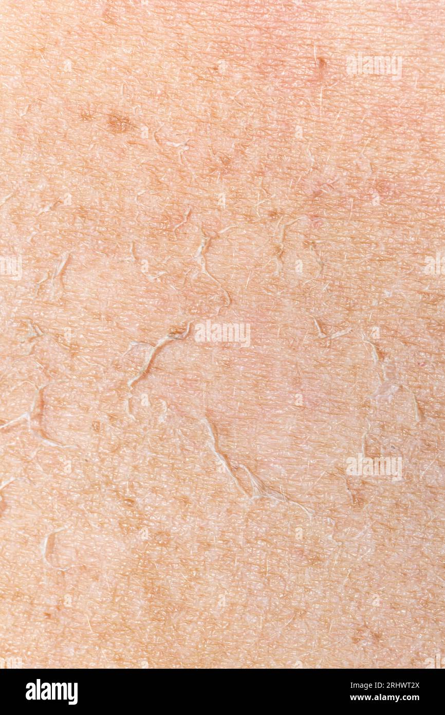 Makro der durch uv-Sonnenstrahlen geschädigten menschlichen Trockenhaut. Nahaufnahme eines kaukasischen Frauenarms mit trockener, abblätternder Haut. Sonnenschutz und Hautpflegekonzept. Stockfoto