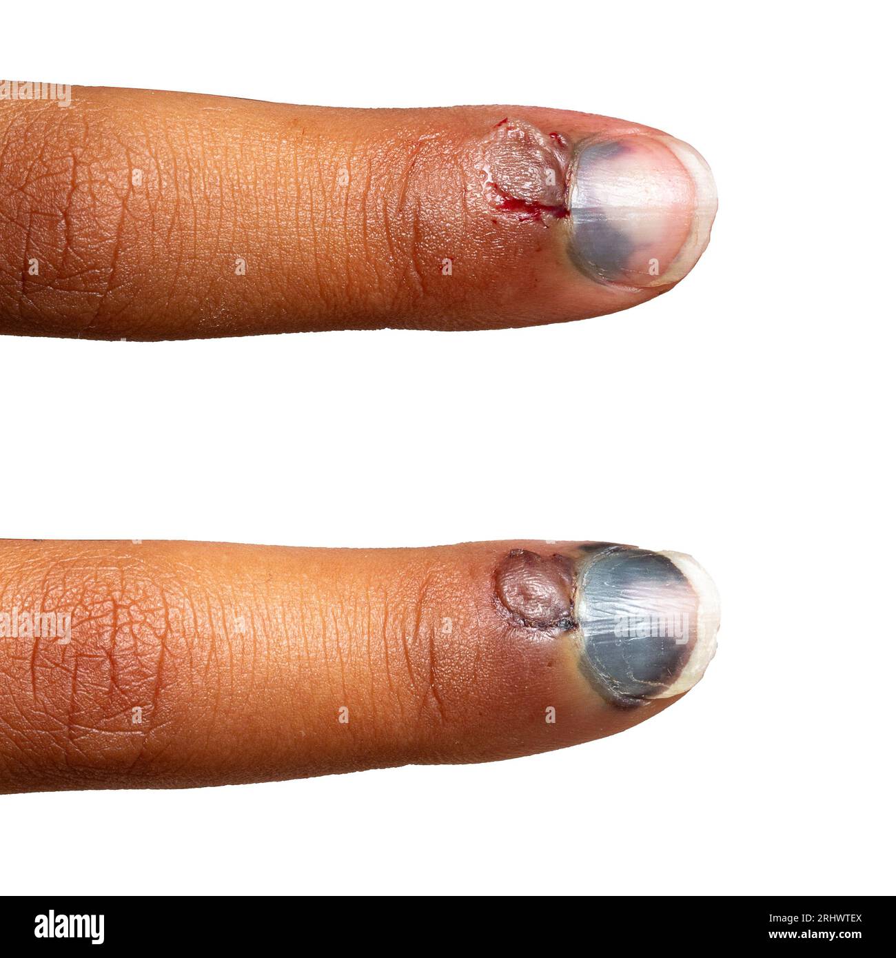 Evolution nach einigen Tagen des Hämatoms eines gequetschten Fingers, Collage vor und nach der Entwicklung des schwarzen Nagels Stockfoto