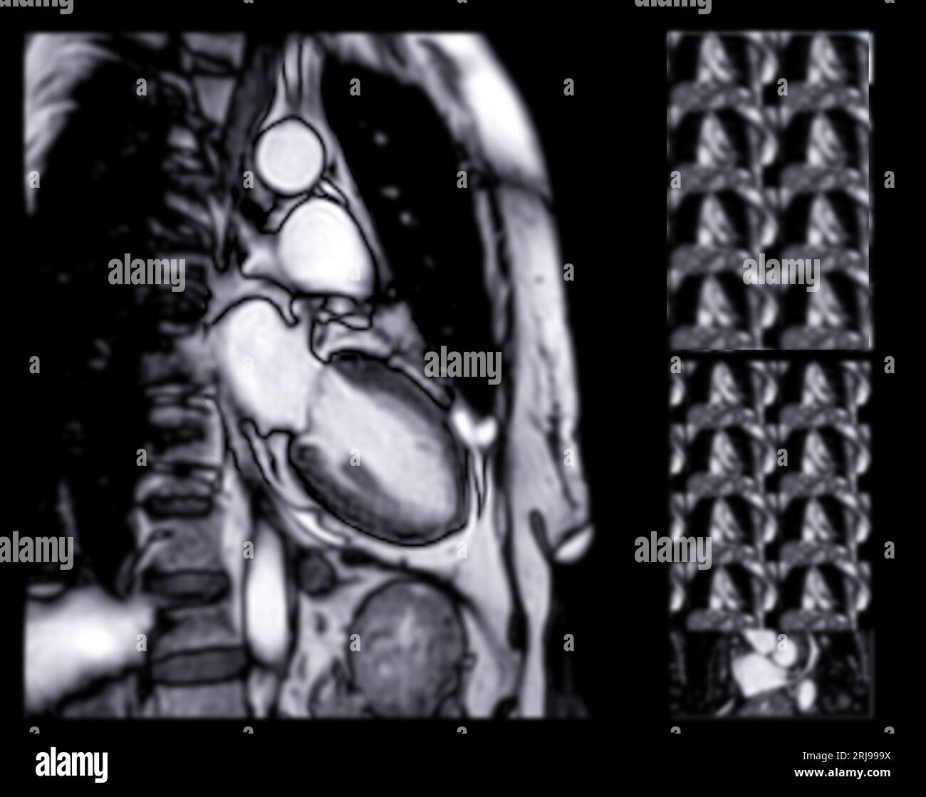 MRT Herz oder Herz-MRT ( Magnetresonanztomographie ) des Herzens zur Diagnostik der Herzkrankheit. Stockfoto