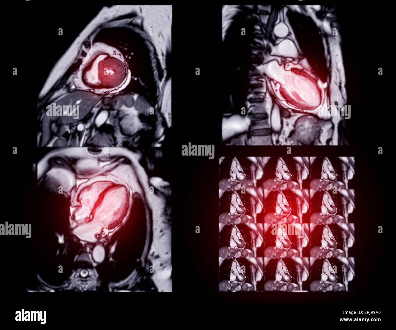 MRT Herz oder Herz-MRT ( Magnetresonanztomographie ) des Herzens zur Diagnostik der Herzkrankheit. Stockfoto