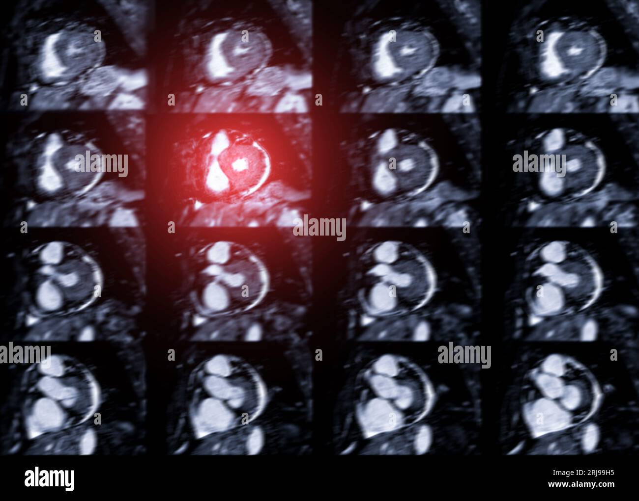 MRT Herz oder Herz-MRT ( Magnetresonanztomographie ) des Herzens zur Diagnostik der Herzkrankheit. Stockfoto