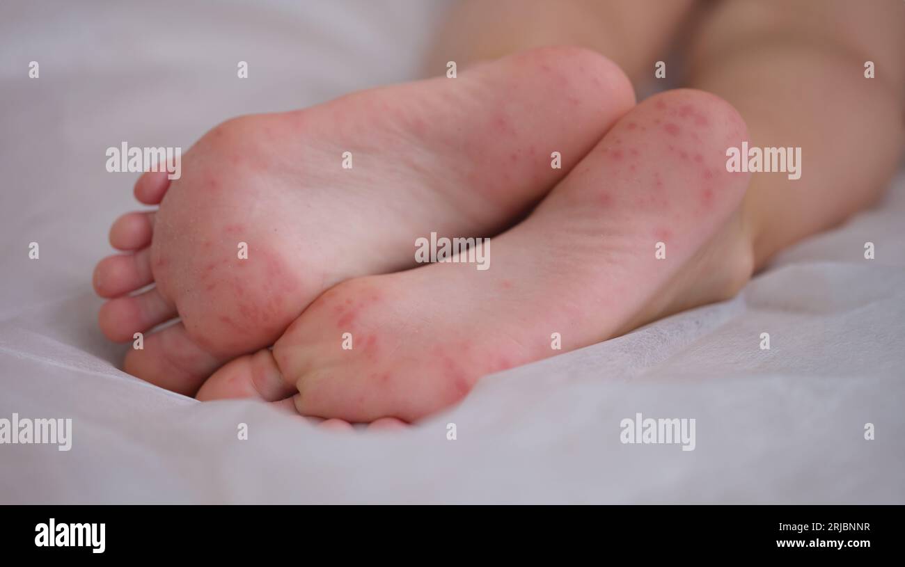 Ein Ekzem ist eine Reizung, die durch eine allergische Läsion der Haut der Füße beim Kind verursacht wird Stockfoto