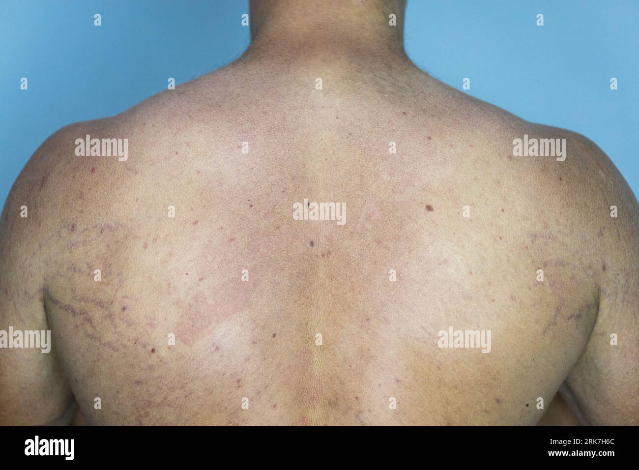 Ein Mann, der an der Hautkrankheit Tinea versicolor mit verfärbten Flecken auf der Haut leidet Stockfoto