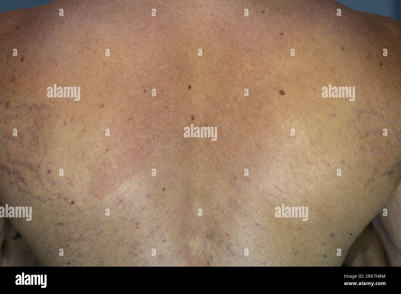 Ein Mann, der an der Hautkrankheit Tinea versicolor mit verfärbten Flecken auf der Haut leidet Stockfoto