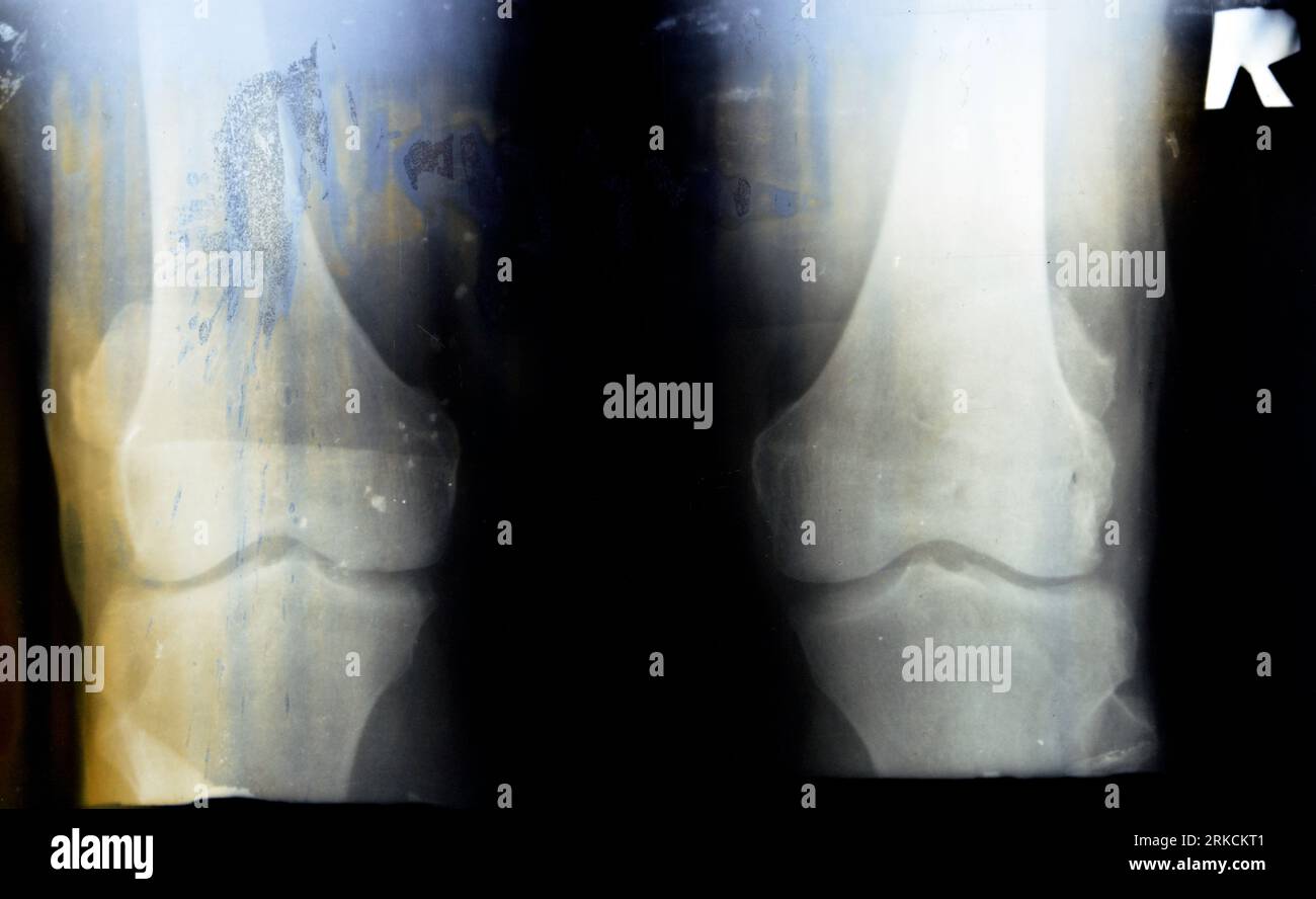Die alte Retro-Plain-Röntgenaufnahme des rechten Knies zeigt eine scheinbare Gelenkarthrose nach Kellgren und Lawrence-System zur Klassifikation der Arthrose mit Stockfoto
