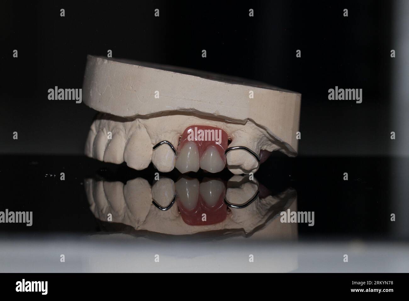 Zahntechniker Modell abnehmbare Prothese PAPM Kobalt-Chrom-Harz-Wachs-Zahnprothesenrahmen Stockfoto