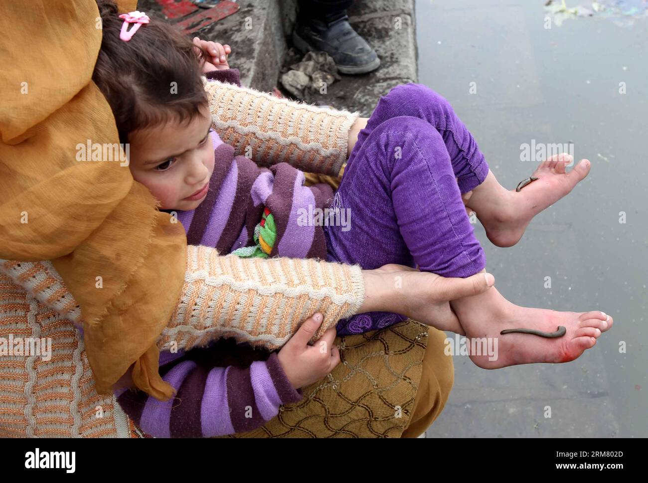 (140321) -- SRINAGAR, 21. März 2014 (Xinhua) -- Blutegel saugen Blut aus den Füßen eines Kindes als Teil einer Behandlung, am Rande von Srinagar, der Sommerhauptstadt des von Indien kontrollierten Kaschmirs, 21. März 2014. Traditionelle medizinische Arbeiter in der indischen kontrollierten Kaschmir verwenden Blutegel, um Hautkrankheiten und Beschwerden wie Arthritis, Gicht, chronische Kopfschmerzen und Sinusitis zu behandeln. (Xinhua/Javed dar) (srb) KASHMIR-SRINAGAR-TRADITIONELLE BEHANDLUNG-BLUTEGEL PUBLICATIONxNOTxINxCHN Srinagar 21. März 2014 XINHUA Blutegel saugen Blut aus den Füssen eines Kindes als Teil einer Behandlung AM Rande von Srin Stockfoto