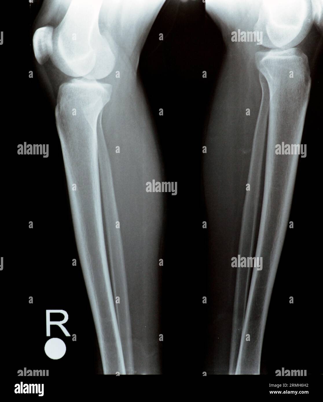 Einfache Röntgenaufnahme des rechten und linken Kniegelenks mit Unterschenkel und Oberschenkelbereich sowie Fibula und Patella mit normaler Knieverbindung von A. Stockfoto