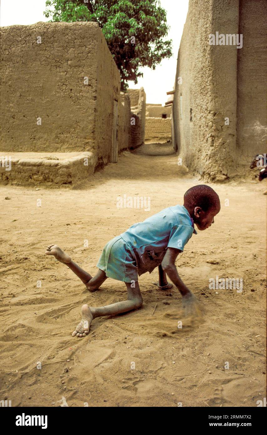 Mali, Djenne. Junge mit Osteomalazie: Defekte Knochenmineralisierung durch unzureichende Nährstoffmengen an Vitamin D oder Calcium. Stockfoto