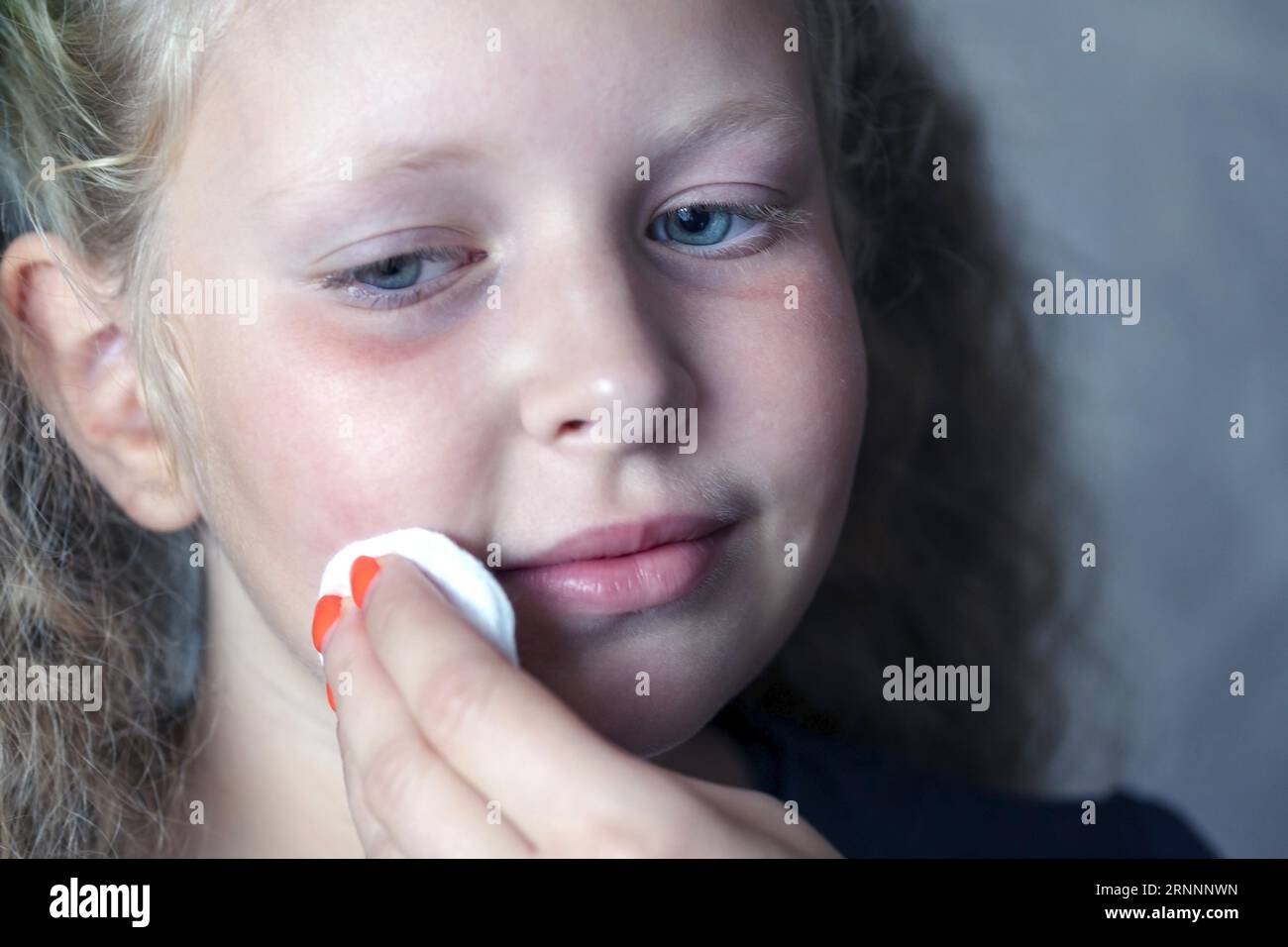 Wischt das Gesicht des Mädchens ab, ein wattiertes Kosmetikpolster. Verärgertes Teenager-Mädchen mit Hautproblem. Konzeptpflege. Teenager- und Kinderprobleme, Hygiene, sauber A Stockfoto