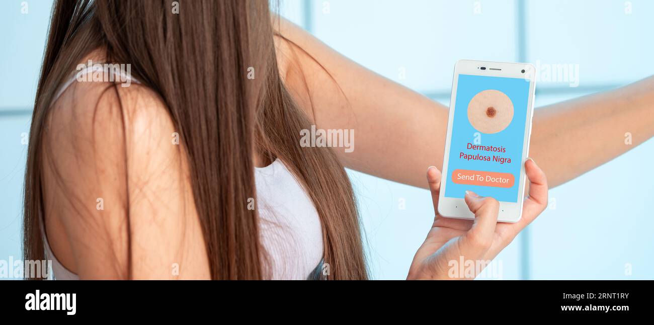 Dermatosis papulosa Nigra: Gutartige, kleine, dunkle Beulen, häufig bei Personen mit dunkleren Hauttönen. Nicht gefährlich. Stockfoto