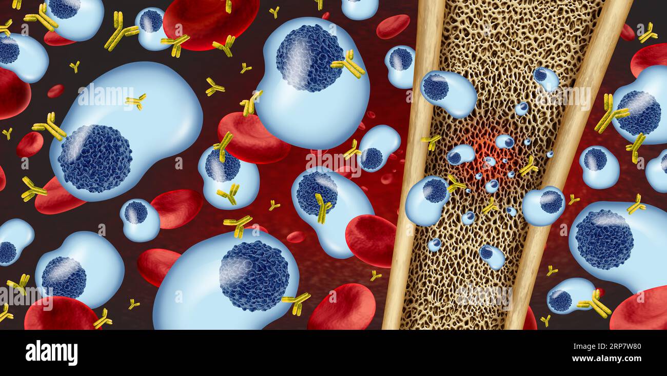Multiples Myelomkonzept und Plasmazellkarzinom als Krebswachstum im Knochenmark. Stockfoto