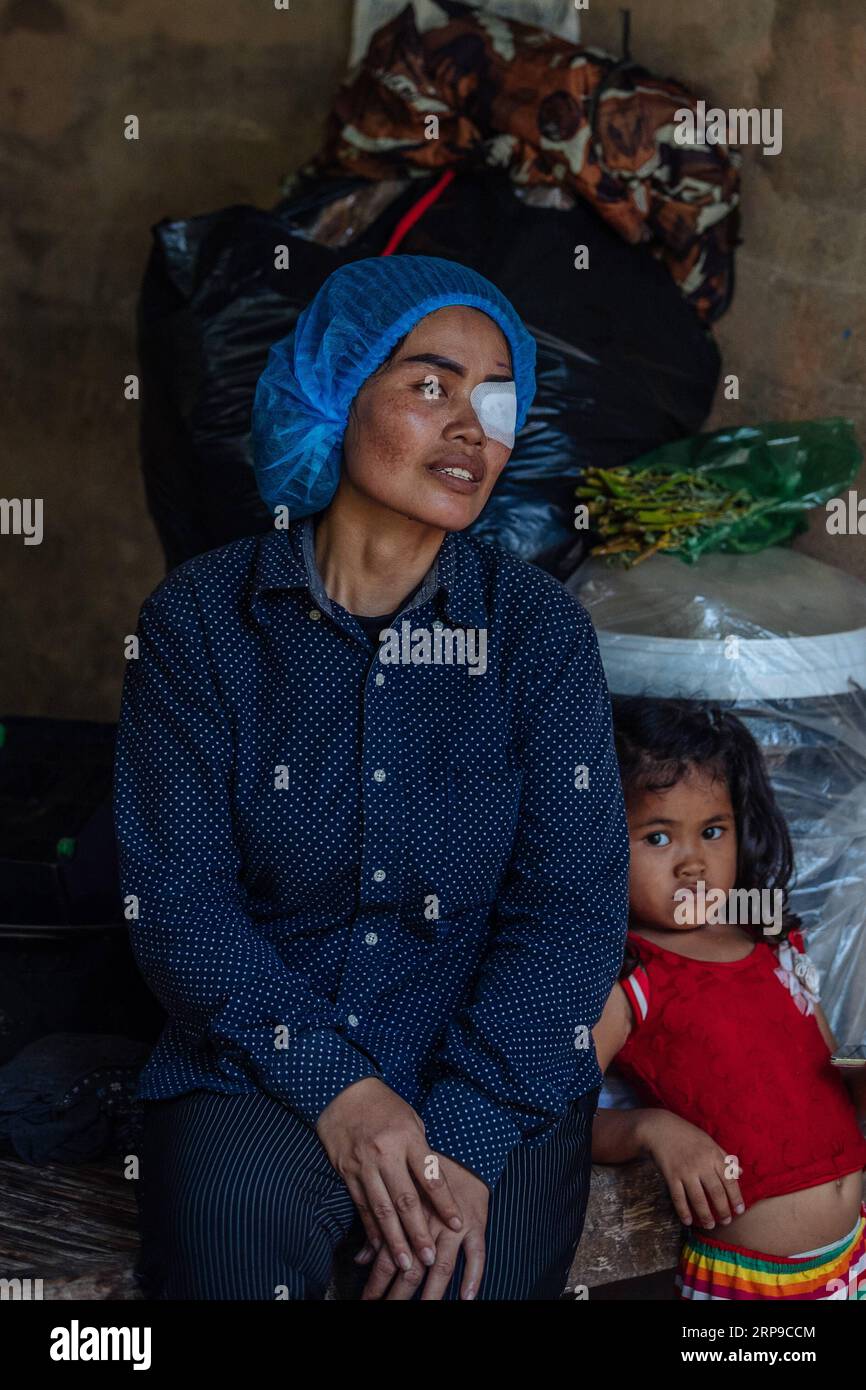 (190402) -- PHNOM PENH, 2. April 2019 (Xinhua) -- Sum Meyle erholt sich mit ihrer Tochter nach einer Katarakt-Operation im Kampong Cham Provincial Hospital in Kampong Cham, Kambodscha, 15. März 2019. Sum Meyle, 36, ist eine alleinerziehende Mutter mit fünf Kindern. Um ihre finanziellen Bedingungen zu verbessern, arbeiten zwei von Meyles Töchtern jetzt in der Hauptstadt Phnom Penh, während zwei ihrer Söhne in einem Kinderheim leben. MEYLE lebt heute mit ihrer jüngsten Tochter in einem gemieteten Shanty House. MEYLE hatte an Katarakt gelitten, nachdem ihr linkes Auge verletzt worden war. Vor sieben Monaten hatte sie Almos Stockfoto