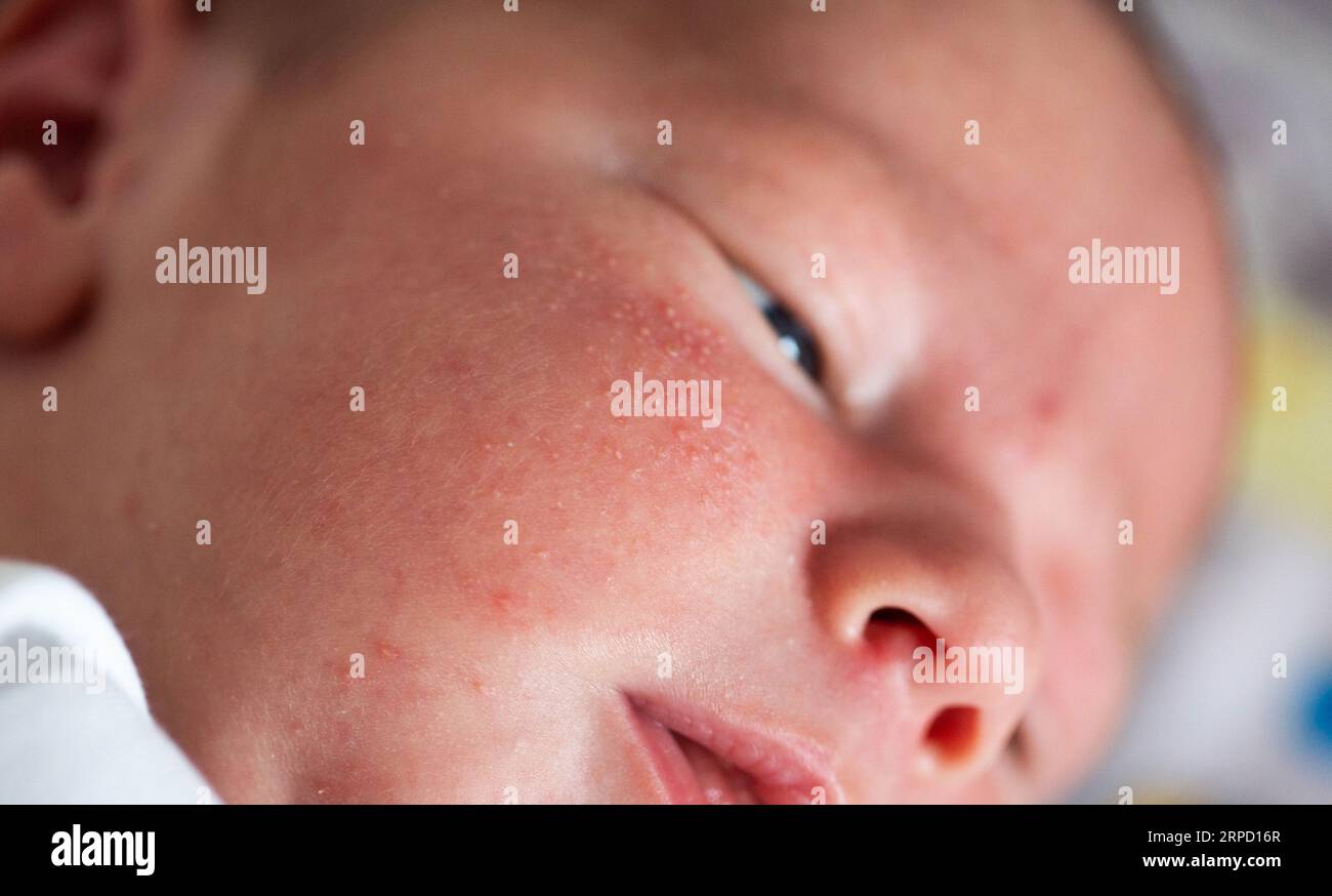 Ausschlag im Gesicht eines Neugeborenen. Der Entstehungsvorgang des Hormonsystems. Stockfoto