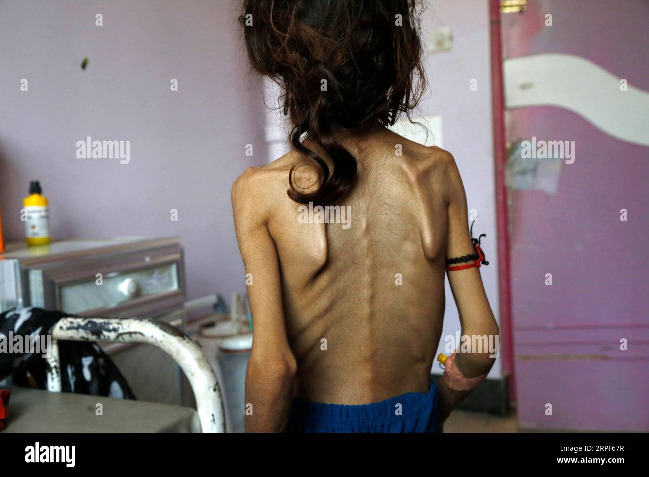 Jemen, Hunger leidende Kinder in Sanaa 190914 -- SANAA, 14. September 2019 -- Sadia Ibrahim steht in ihrem Zimmer, wo sie am 12. September 2019 in einem Zentrum zur Behandlung von Mangelernährung im Al-Sabeen Krankenhaus in Sanaa, Jemen, medizinisch behandelt wird. Sadia Ibrahim hat sich benommen gefühlt, nachdem der Arzt sie als Haut und Knochen diagnostiziert hat. Das 11-jährige, stark unterernährte Mädchen wiegt heute etwa 12 kg. Sie liegt auf einem Bett im Al-Sabeen Krankenhaus in der jemenitischen Hauptstadt Sanaa, um behandelt zu werden, da Ärzte und ihre armen Eltern versuchen, ihr Leben zu retten. ZUM Spiel: Hunger tötet den Jemen Stockfoto