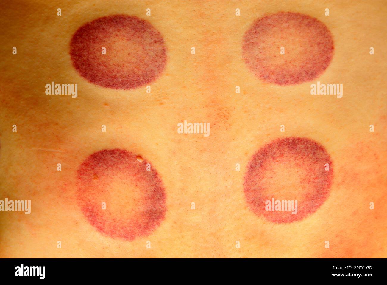 Schröpftherapie, chinesische traditionelle medizinische Methode Markierungen auf der Haut, Nahaufnahme des Fotos Stockfoto