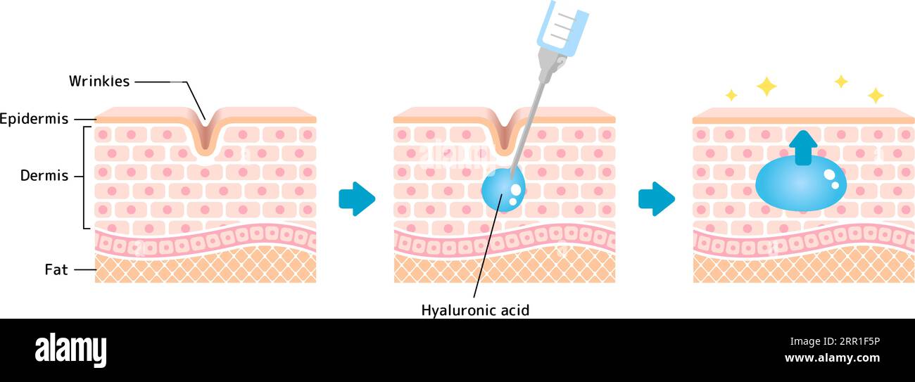 Abbildung des Mechanismus der Hyaluronsäure-Injektion (Querschnitt der Haut) Stock Vektor