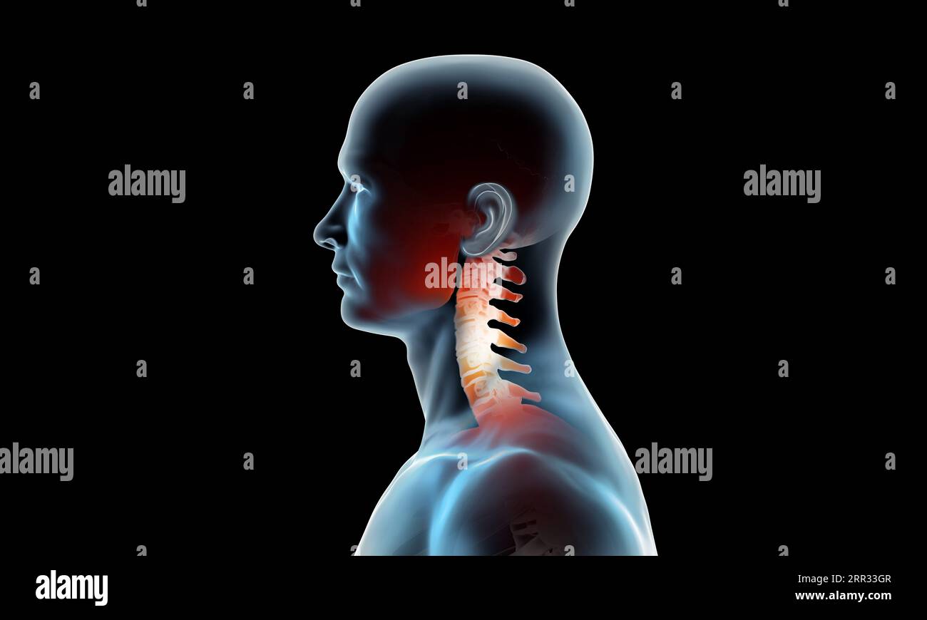 Seitenansicht des zervikalen Schnitts bei Wirbelsäulenverletzung und Schmerzen auf schwarzem Hintergrund Stockfoto