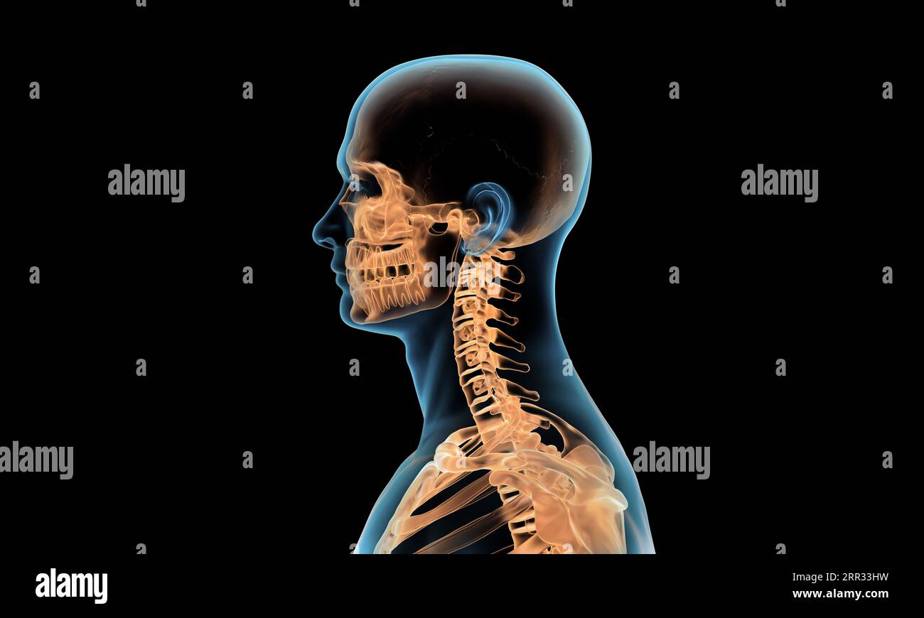 Seitenansicht der Halswirbelsäule bei Wirbelsäulenverletzung und Schmerzen Stockfoto