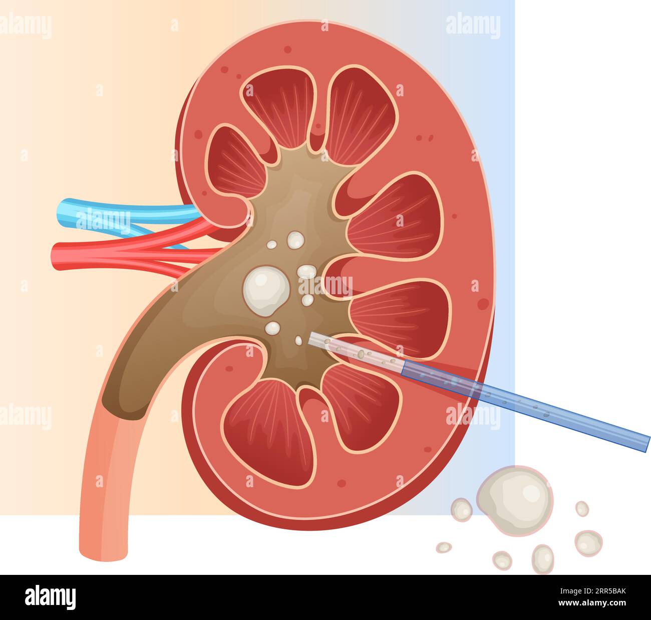 Nierensteinentfernung - perkutane Nephrolithotomie - Stockabbildung als EPS 10-Datei Stock Vektor