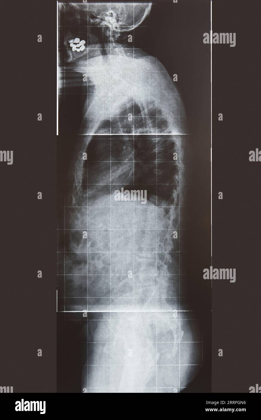 Röntgenaufnahme der Lendenwirbelsäule. Seitenansicht. Gesundheitswesen. Bilddiagnose Stockfoto