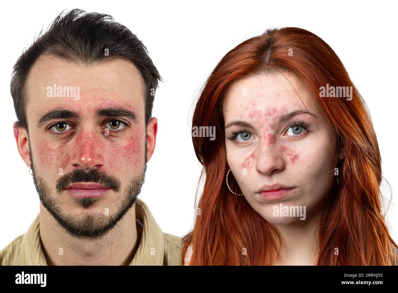 Couperose männlich und weiblich. Akne rosacea bei Mann und Frau. Rötung der Haut. Isolierte Personen auf weißem Hintergrund Stockfoto