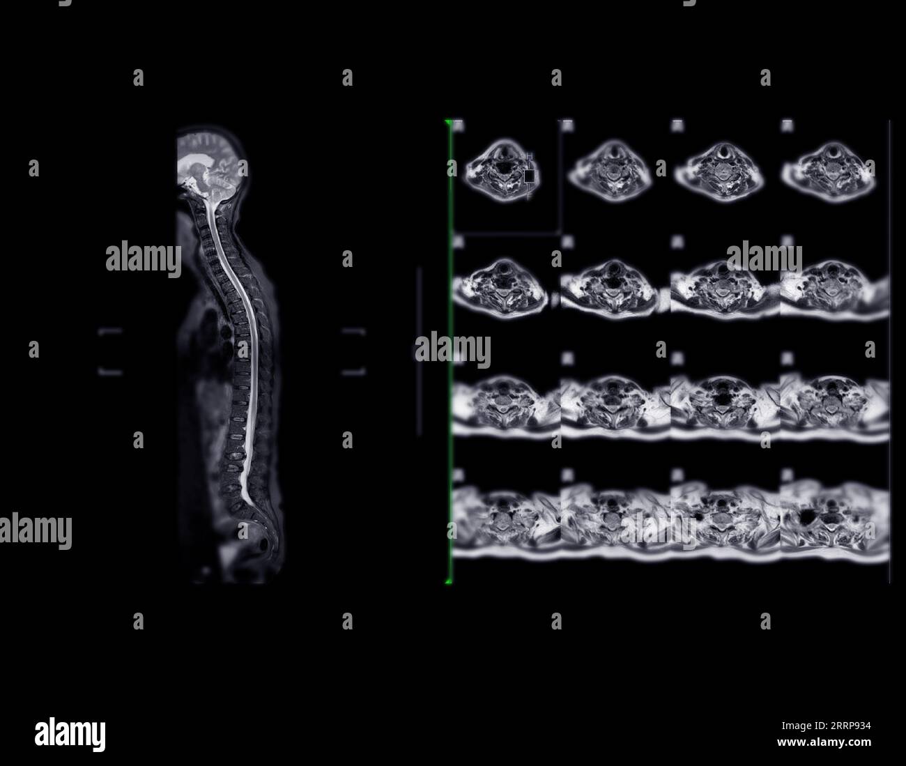MRT-Ganzdorn-Screening zur Diagnose Rückenmarkskompression. Stockfoto