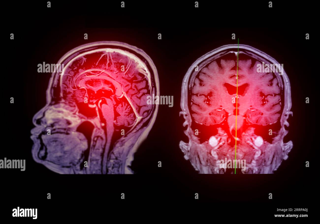 MRT-Hirnscan sagittale und koronale Ansicht mit Referenzlinie zur Erkennung von Hirnerkrankungen als Schlaganfallerkrankung, Hirntumoren und Infektionen. Stockfoto