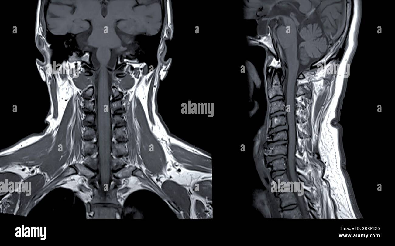 MRT der C-Wirbelsäule oder Magnetresonanzbild der Halswirbelsäule koronale und sagittale Sicht zur Diagnostik von Spondylose und Kompressionsfraktur. Stockfoto
