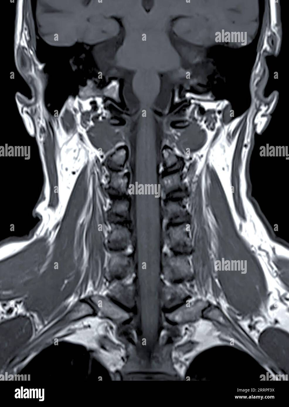 MRT der C-Wirbelsäule oder Magnetresonanzbild der Halswirbelsäule koronale Sicht zur Diagnostik von Spondylose und Kompressionsfraktur. Stockfoto