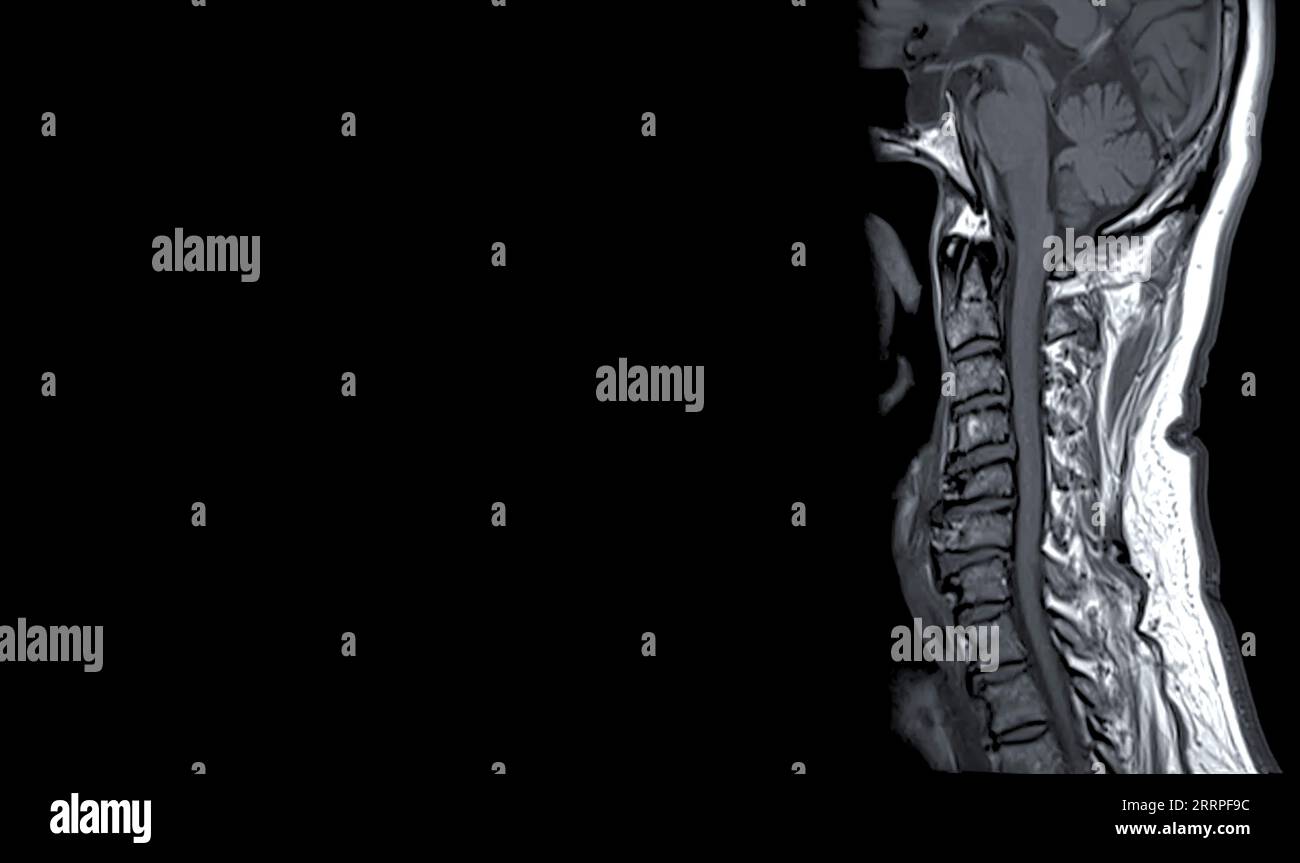 MRT der C-Wirbelsäule oder Magnetresonanzbild der Halswirbelsäule in sagittaler Sicht zur Diagnostik von Spondylose und Kompressionsfraktur. Stockfoto