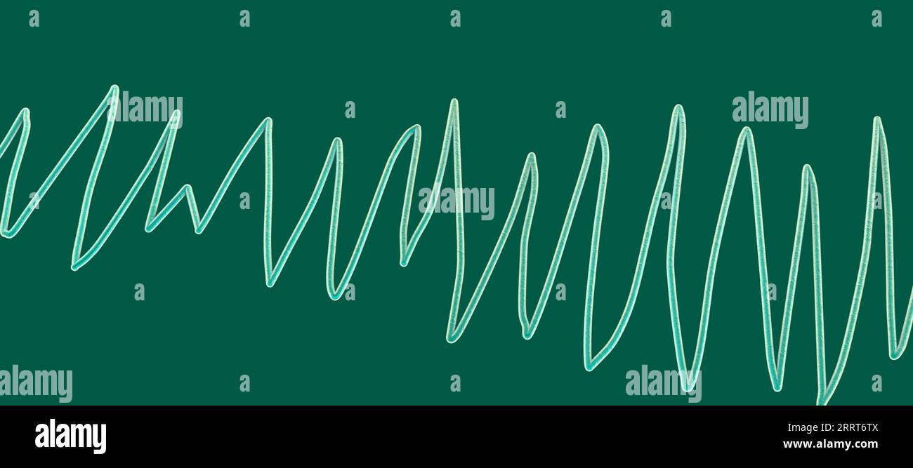 Torsades de pointes Herzrhythmus, Illustration Stockfoto