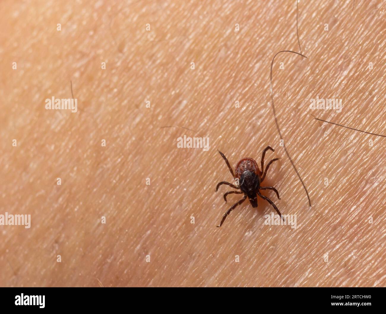 Infizierte weibliche Hirschzecke auf behaarter menschlicher Haut. Ixodes ricinus. Parasitäre Milbe. Acarus. Gefährliches Bissinsekt auf Epidermis-Detailhintergrund. Disg Stockfoto