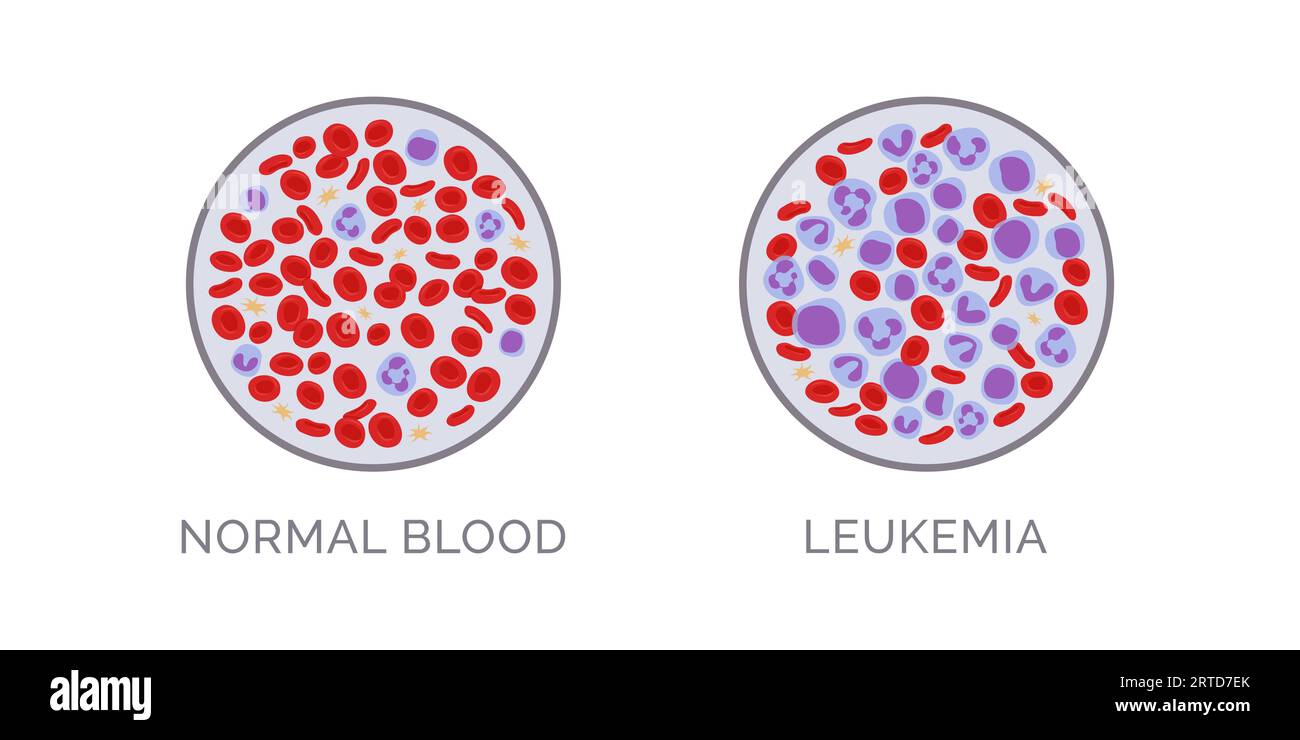 Bluttestvergleich: Normal und Leukämie, Blutkrebsdiagnostik Stock Vektor