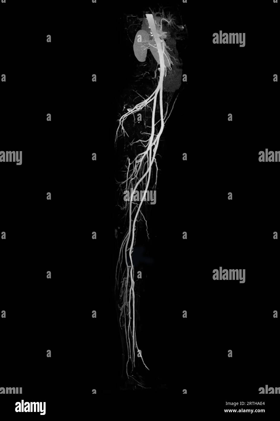 CTA-Ablauf der Femoralarterie zeigt Femoralarterie für die Diagnose akuter oder chronischer peripherer arterieller Verschlusskrankheit. Stockfoto