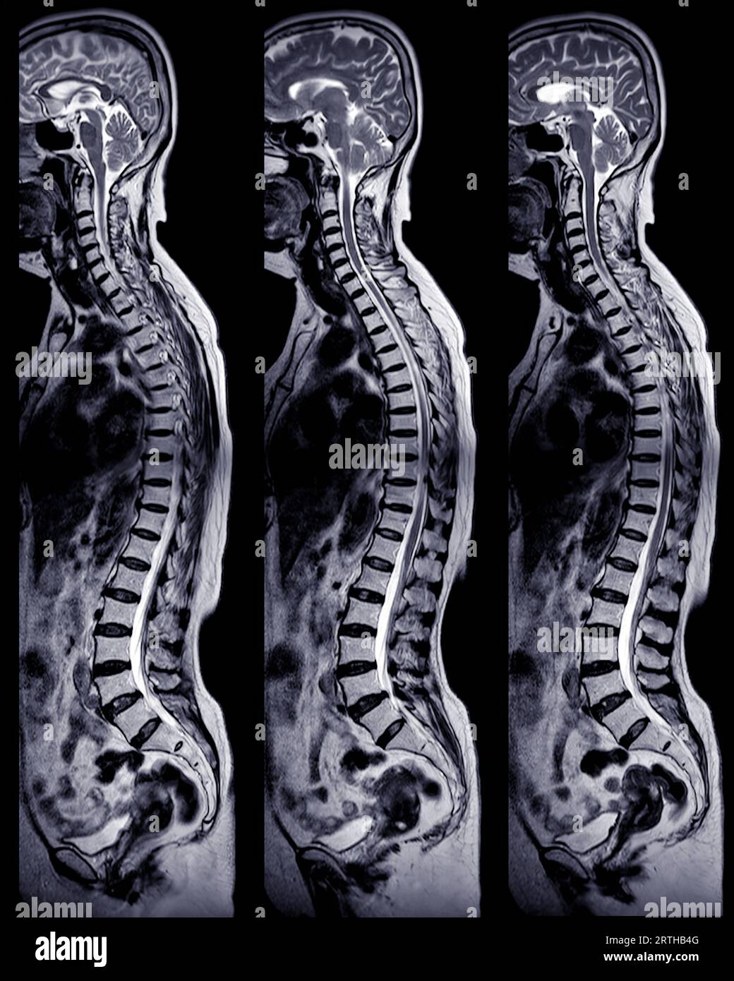 MRT-Ganzdorn-Screening zur Diagnose Rückenmarkskompression. Stockfoto