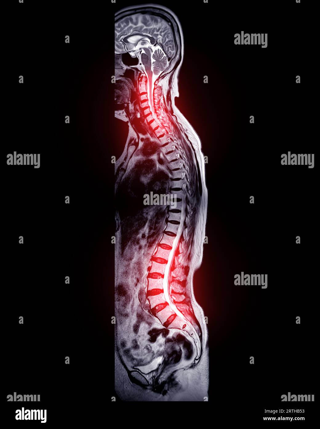 MRT-Ganzdorn-Screening zur Diagnose Rückenmarkskompression. Stockfoto