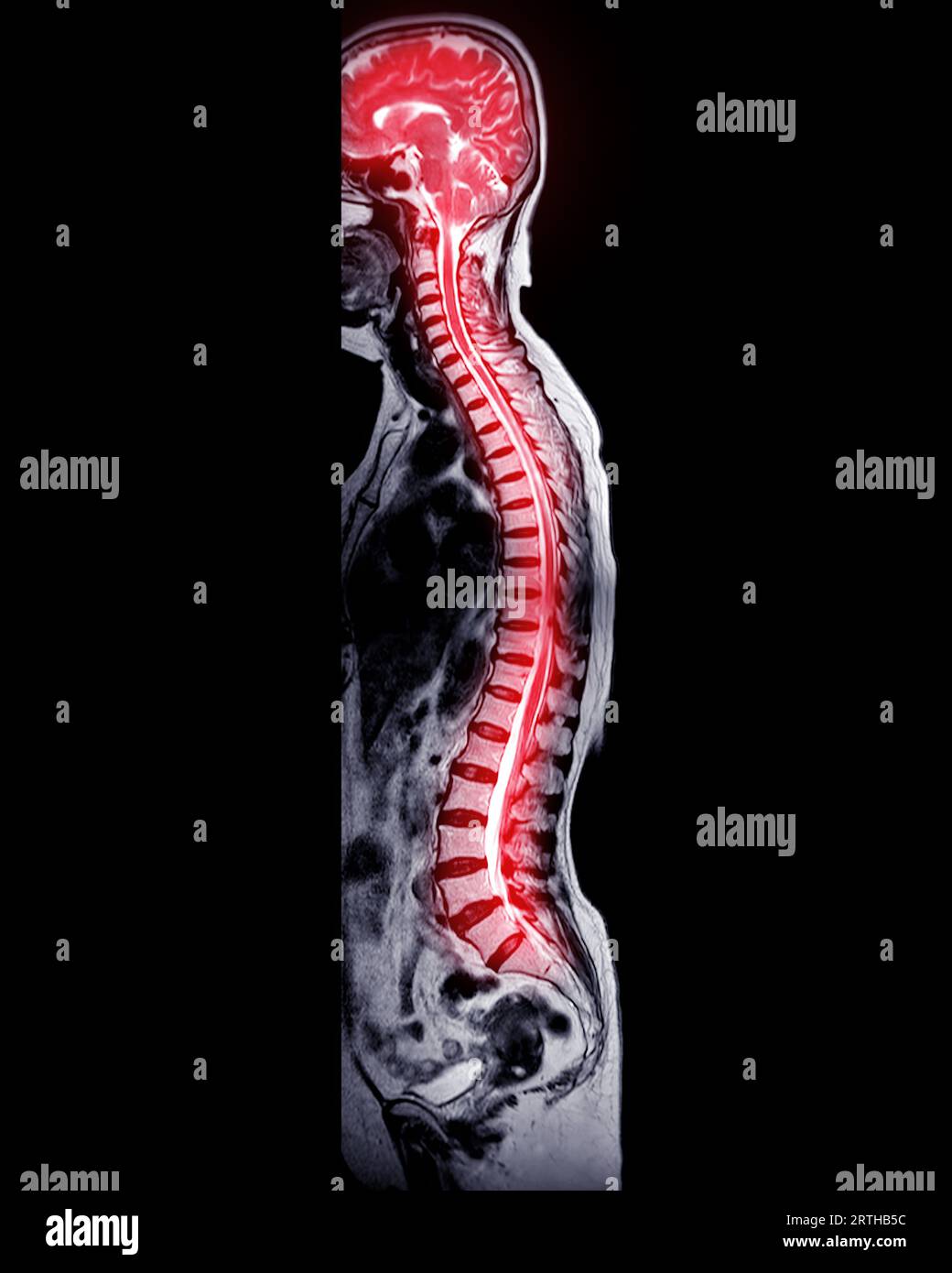 MRT-Ganzdorn-Screening zur Diagnose Rückenmarkskompression. Stockfoto