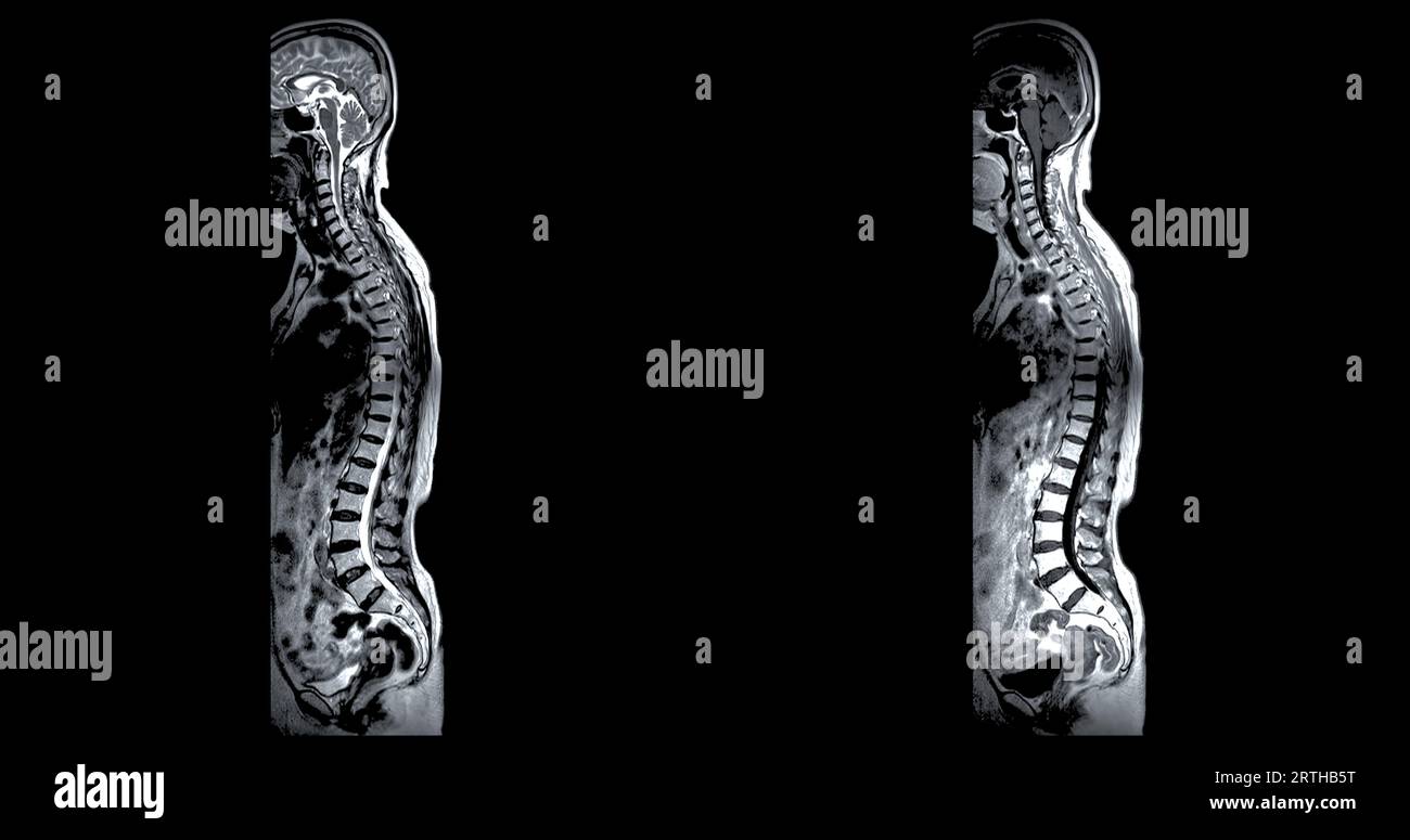 MRT-Ganzdorn-Screening zur Diagnose Rückenmarkskompression. Stockfoto