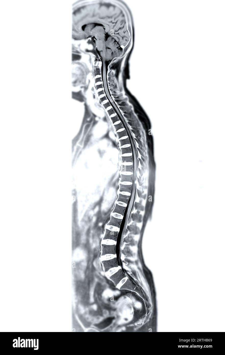 MRT-Ganzdorn-Screening zur Diagnose Rückenmarkskompression. Stockfoto