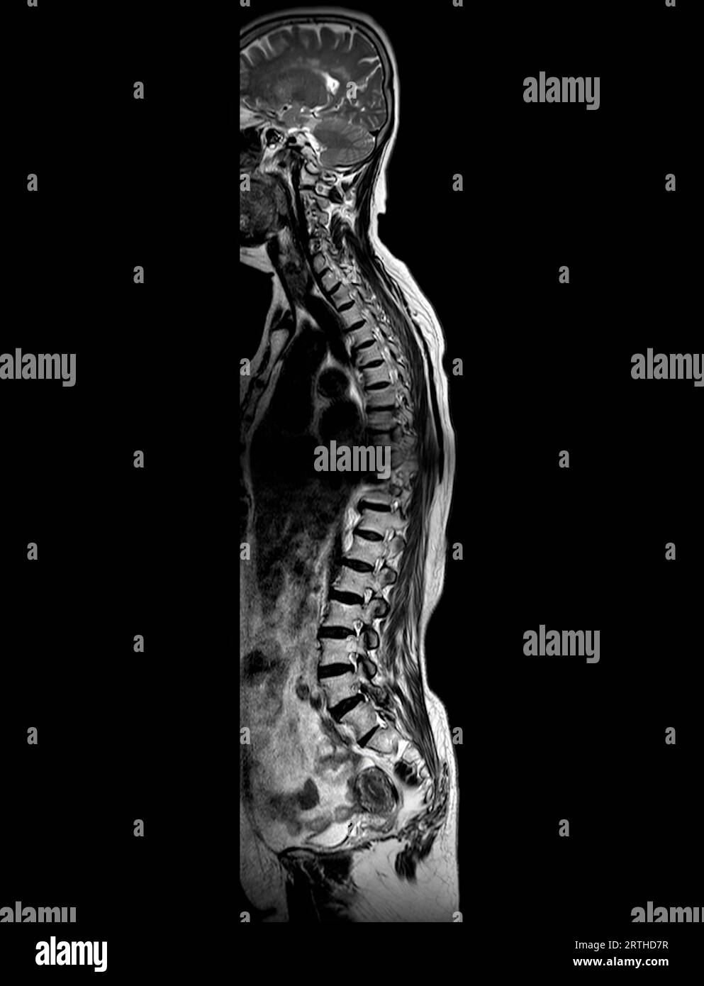 MRT-Ganzdorn-Screening zur Diagnose Rückenmarkskompression. Stockfoto