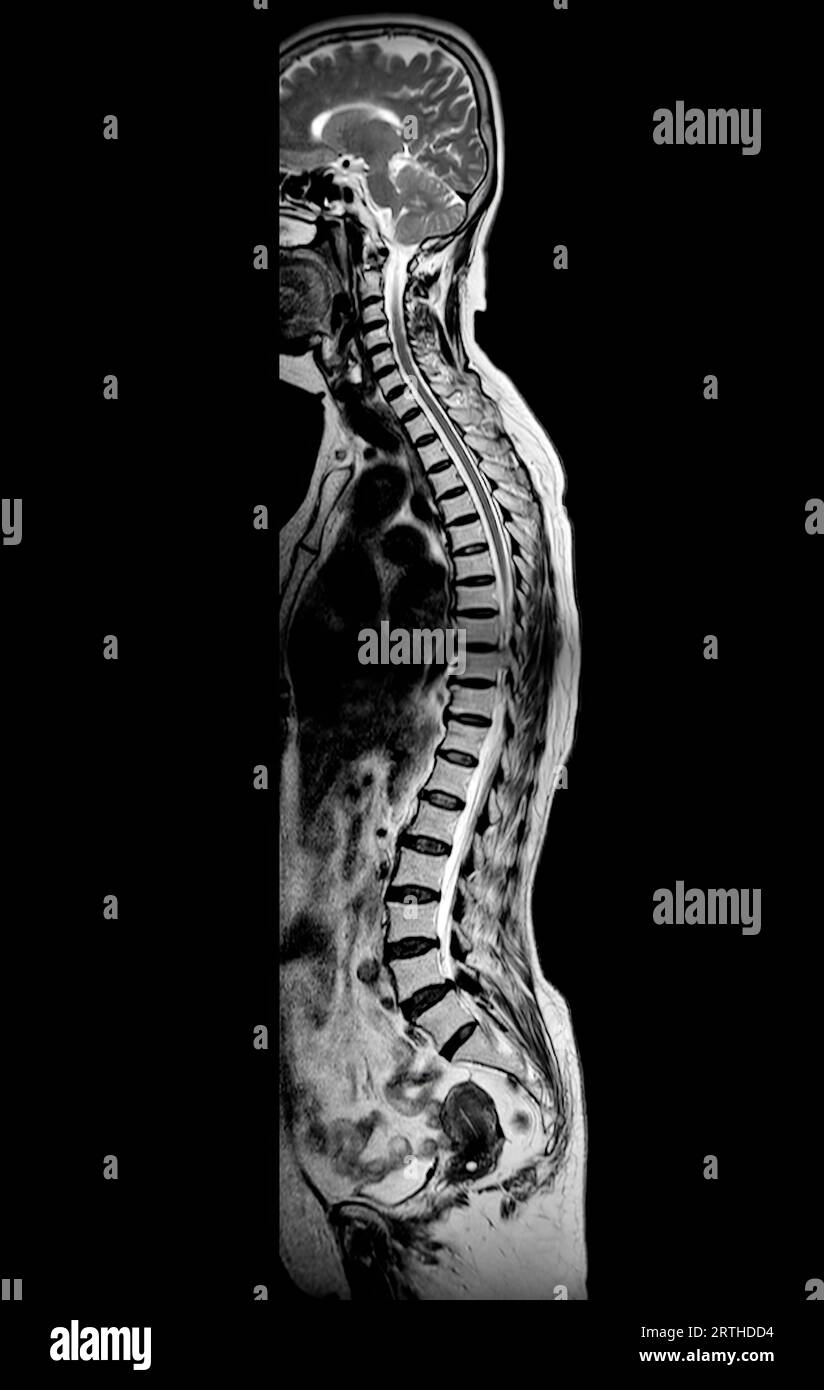 MRT-Ganzdorn-Screening zur Diagnose Rückenmarkskompression. Stockfoto