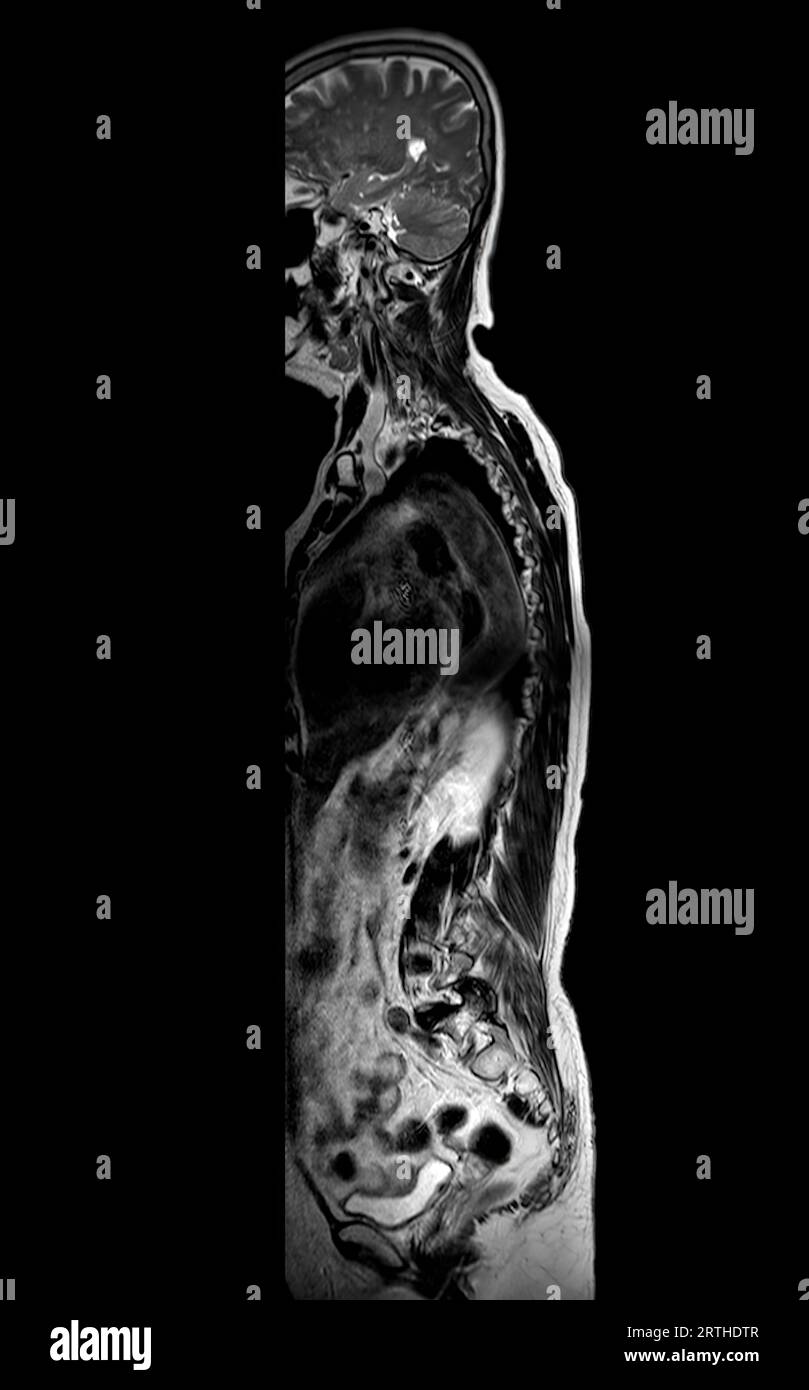 MRT-Ganzdorn-Screening zur Diagnose Rückenmarkskompression. Stockfoto