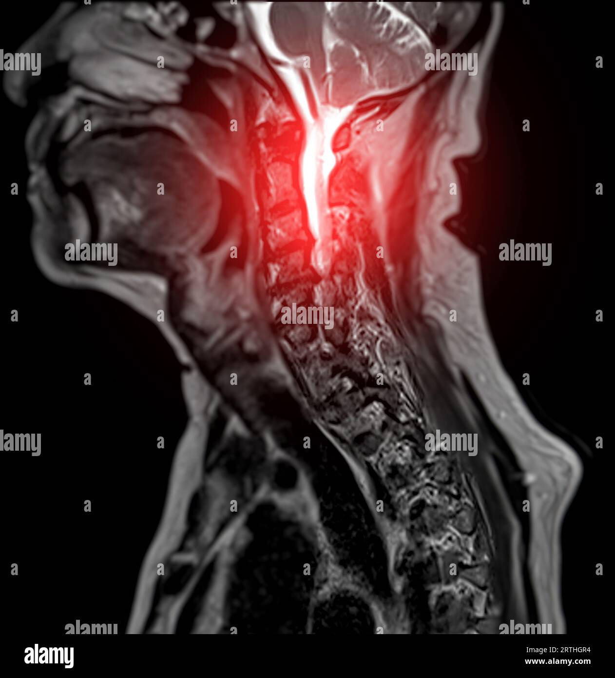 MRT der C-Wirbelsäule oder Magnetresonanzbild der sagittalen T2 FS-Ansicht der Halswirbelsäule zur Diagnose der Spondylose, die die zervikale spondylotische Myelopathie A verursacht Stockfoto